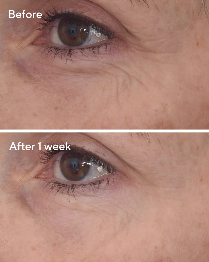 Retinal ReSculpt™  Eye Lift Treatment
